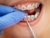 What Kind of Braces are the Best Choice for Me? braces