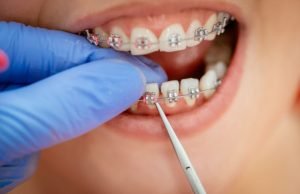What Kind of Braces are the Best Choice for Me? braces